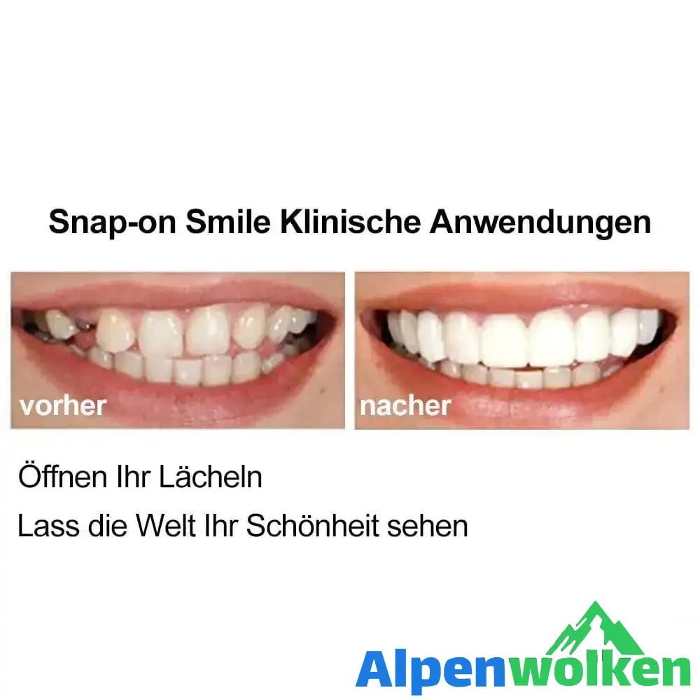 Alpenwolken - 1 SET DIAMOND SMILE VENEERS (OBEN & UNTEN ZÄHNE)