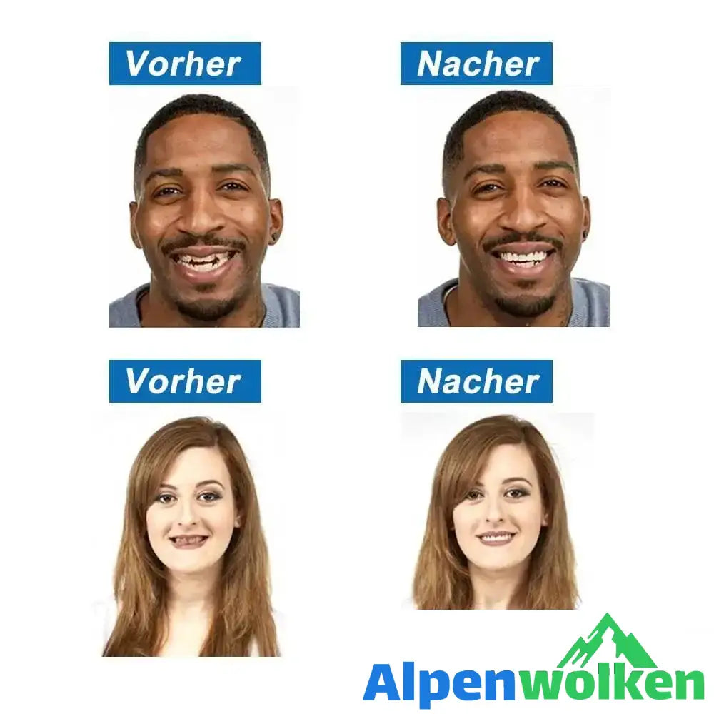 Alpenwolken - 1 SET DIAMOND SMILE VENEERS (OBEN & UNTEN ZÄHNE)