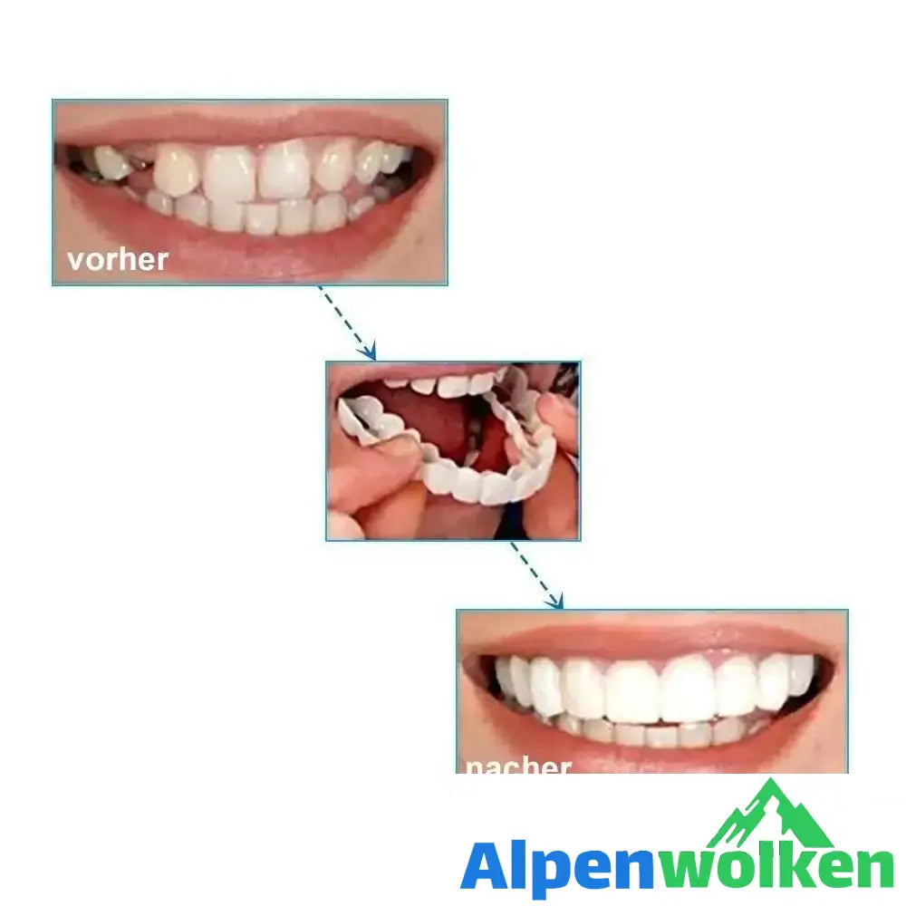 Alpenwolken - 1 SET DIAMOND SMILE VENEERS (OBEN & UNTEN ZÄHNE)