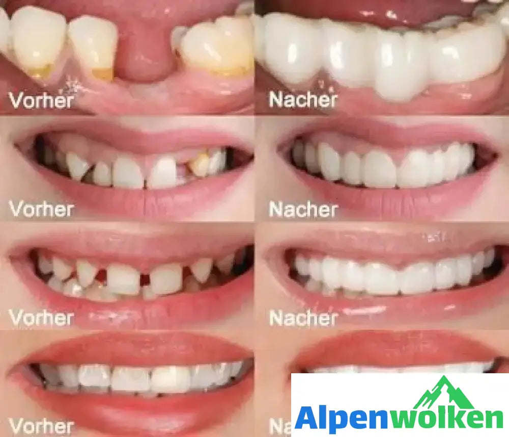 Alpenwolken - 1 SET DIAMOND SMILE VENEERS (OBEN & UNTEN ZÄHNE)